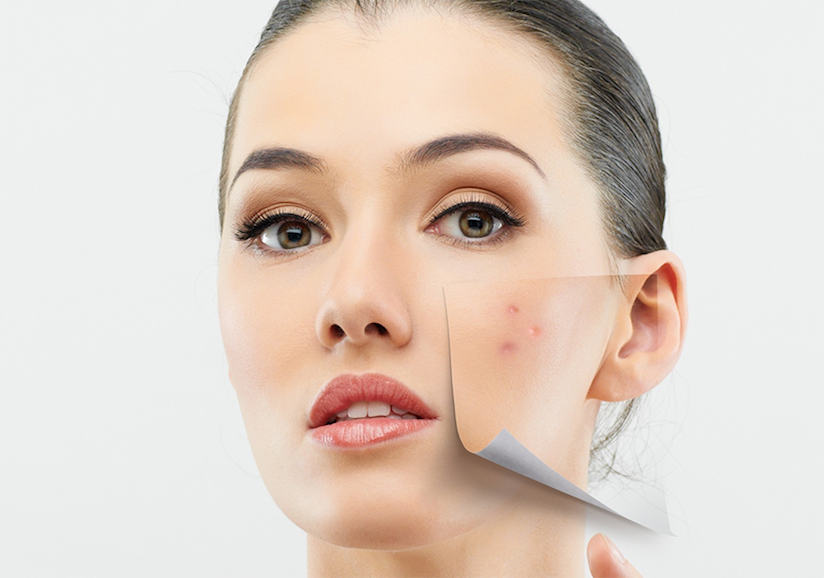 Acne-behandelin